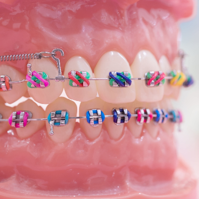 Orthodontic Braces