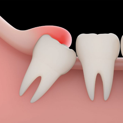 Impaction Surgery