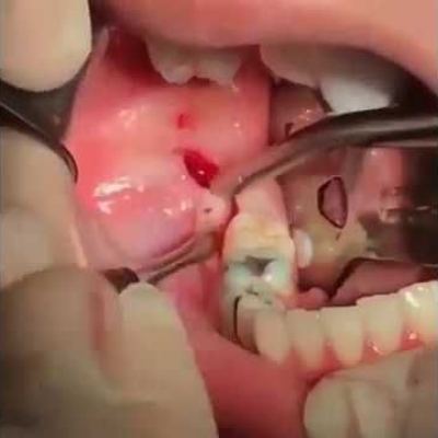 Impaction Surgery