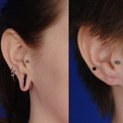 Cosmetic Surgery-PRP-PRF-Torn Ear Surgery