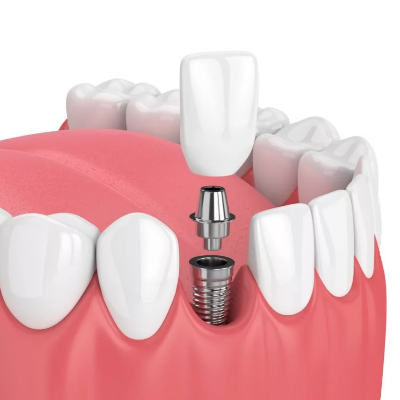 Dental Implants 