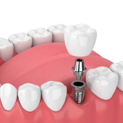 Dental Implants 